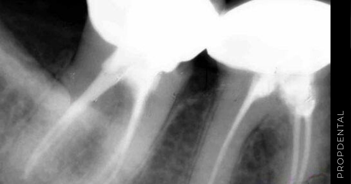 La radiografía periapical para el diagnóstico de caries