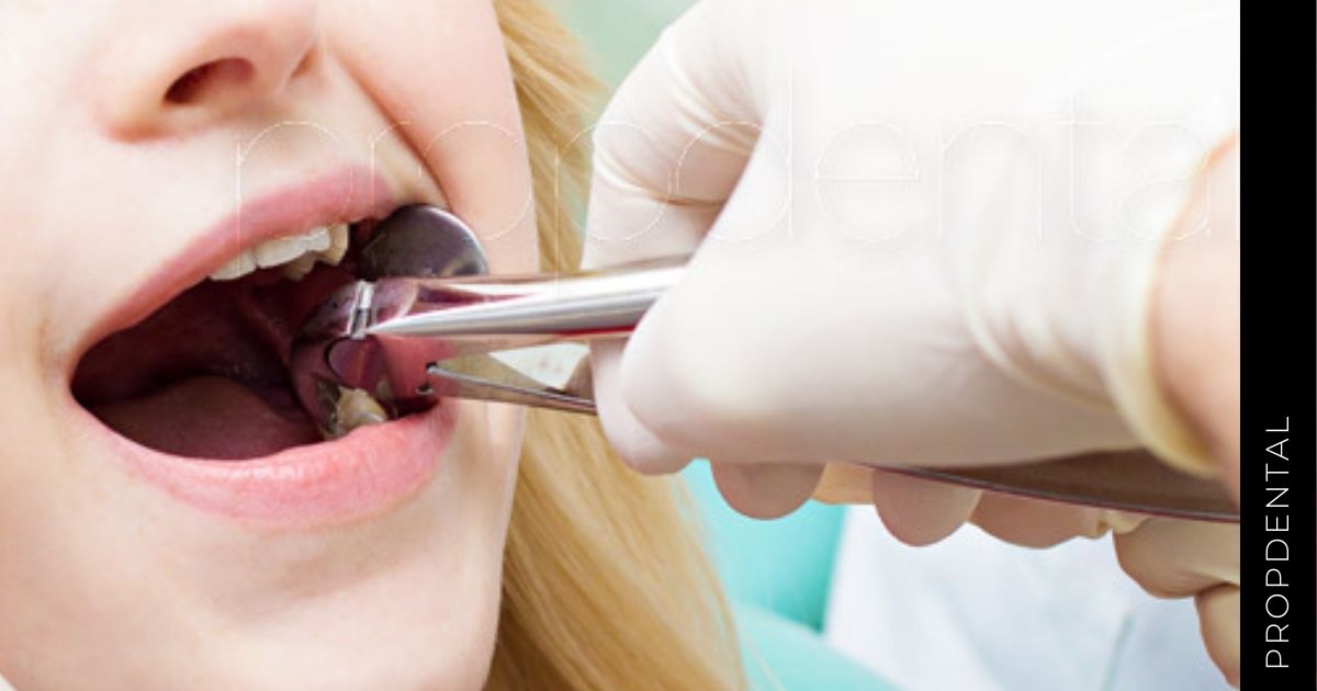 La técnica de exodoncia en dentición temporal