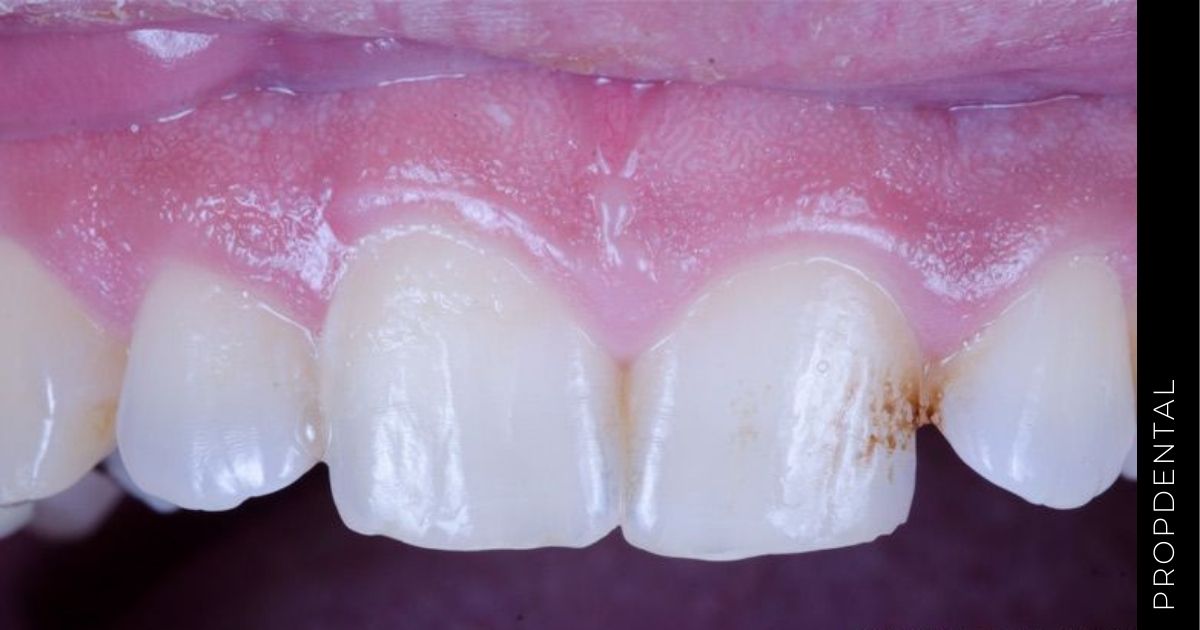 Las manchas dentales