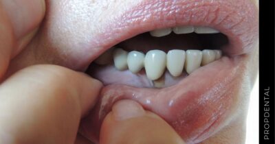 Lesión periodontal primaria