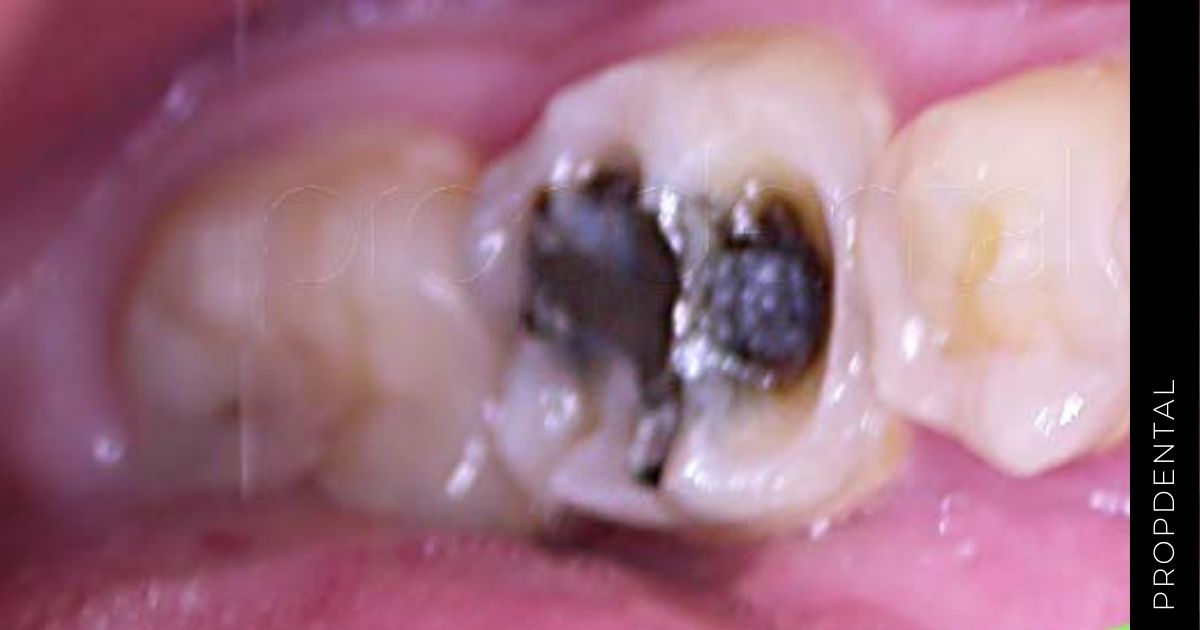 Mancha en los dientes o caries