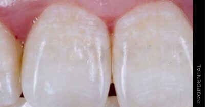 Manchas blancas en los dientes