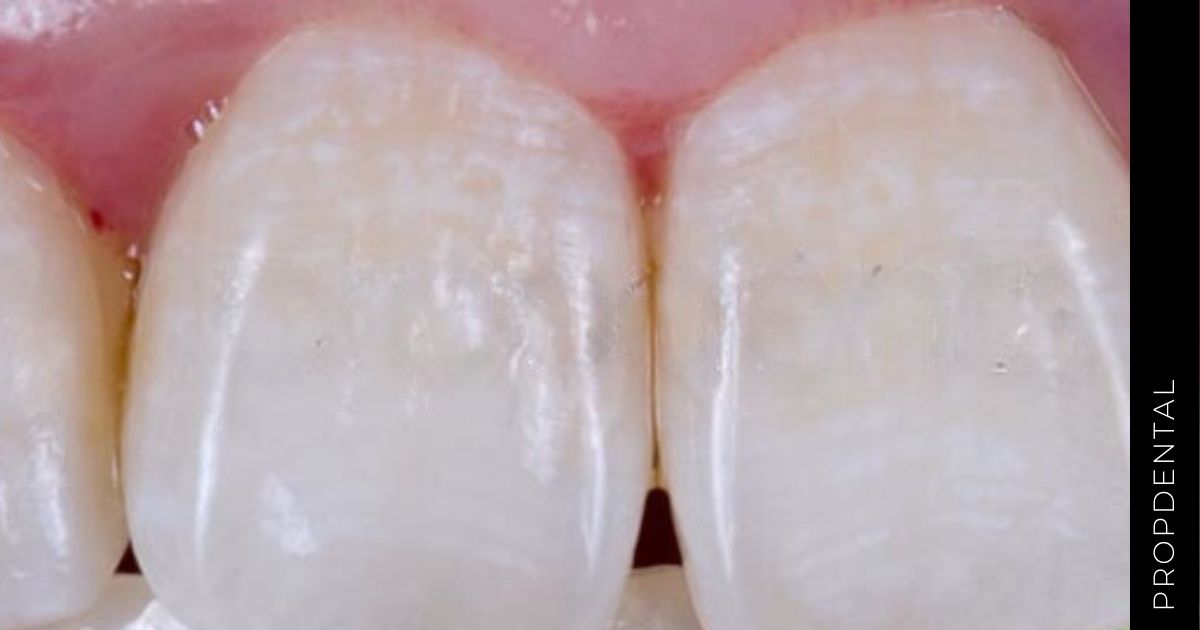 Manchas blancas en los dientes
