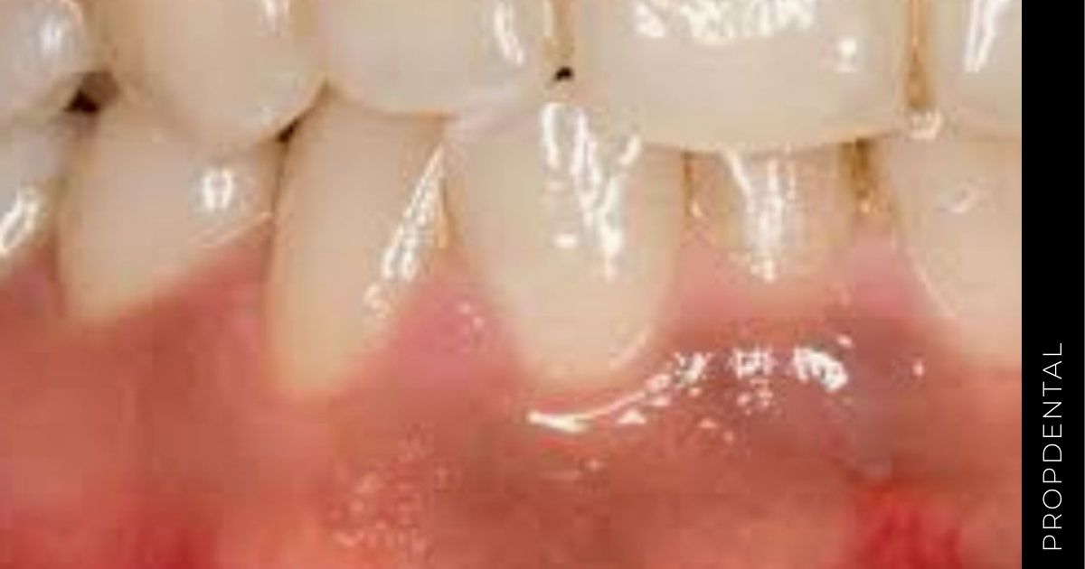 Melanosis gingival