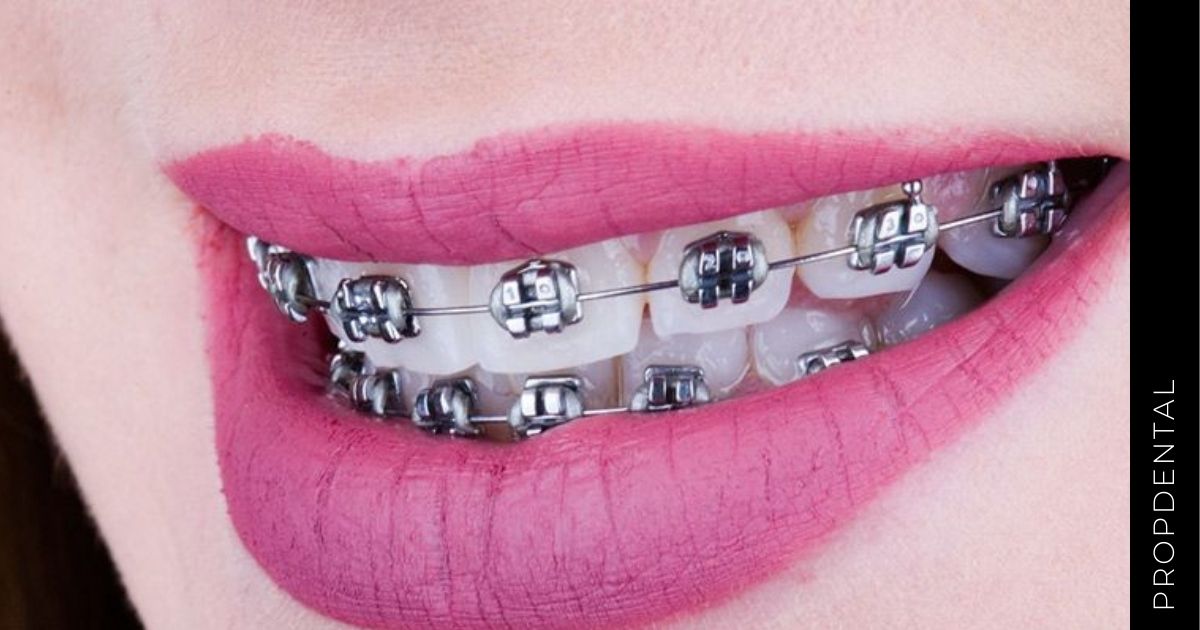 Métodos para alinear tus dientes