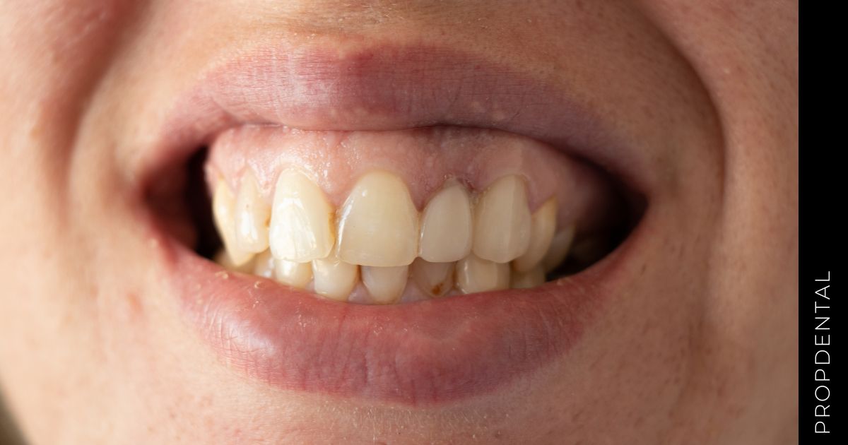 ¿Mis dientes tienen una coloración anómala?