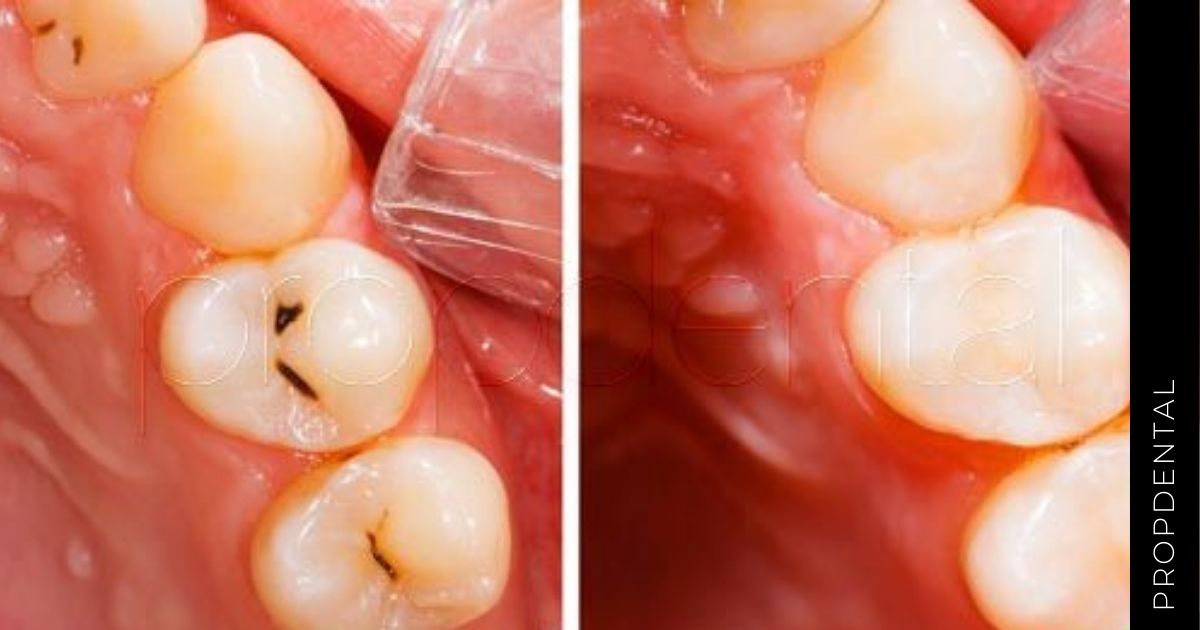 Molestias tras el empaste dental