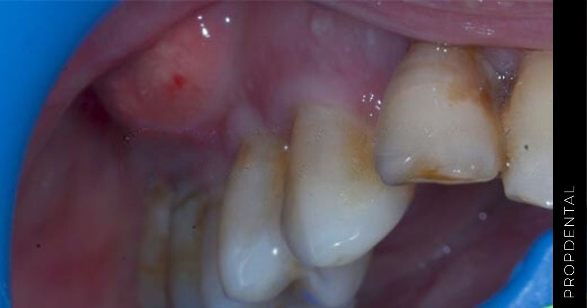 Peligros de los abscesos dentales