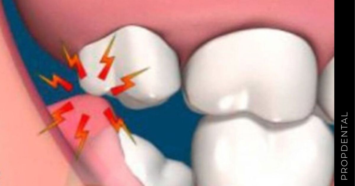 Pericoronaritis