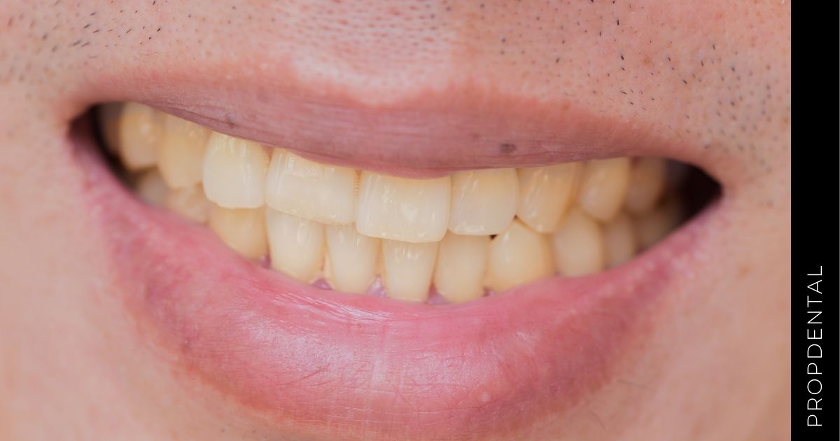 Por qué los dientes permanentes salen amarilos?