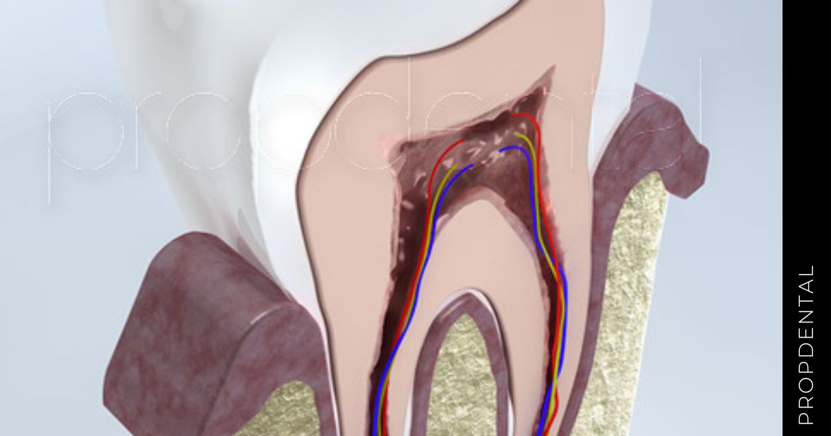 ¿Por qué se infecta el nervio dental?
