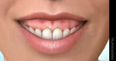 ¿Por qué tengo la sonrisa gingival?