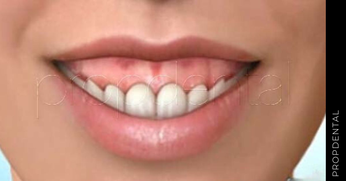 ¿Por qué tengo la sonrisa gingival?