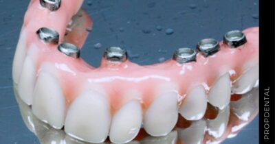 Prótesis sobre implantes dentales fijas vs removibles