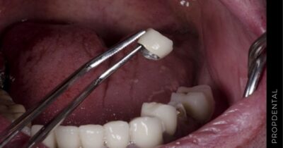 Puente dental despegado