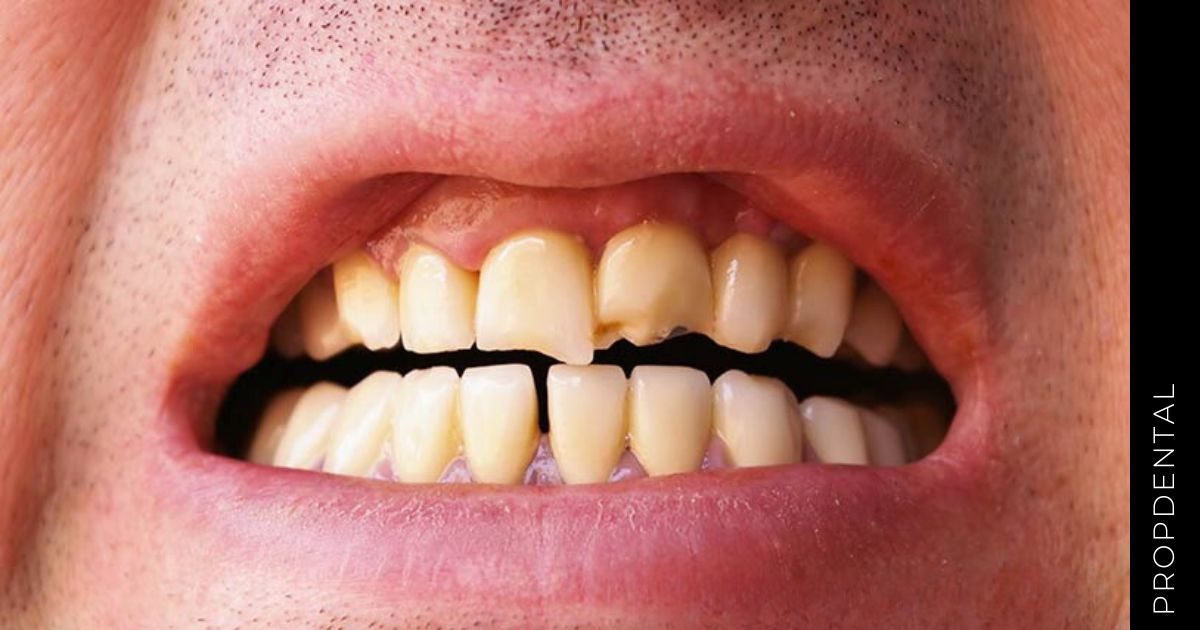 ¿Qué debemos hacer ante un traumatismo dental?