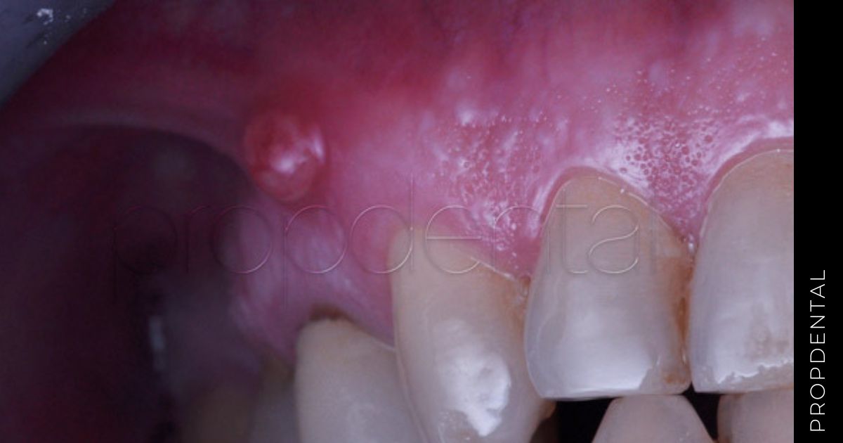 ¿Qué es y como se trata un flemón dental?