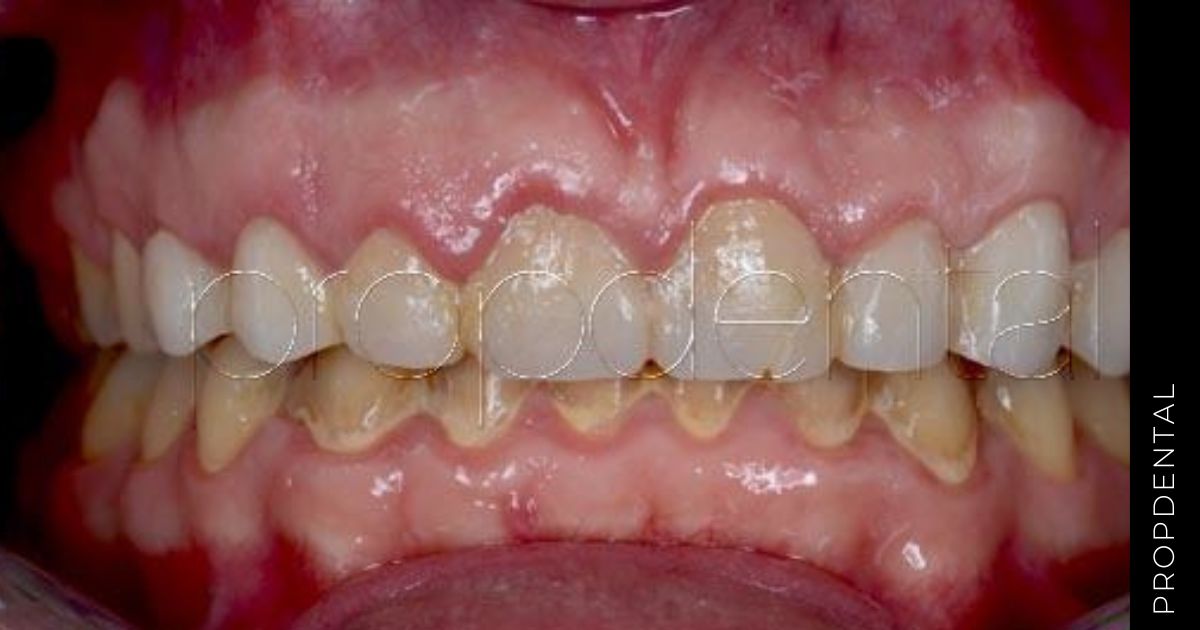 ¿Qué pasa si no te lavas los dientes en un año?