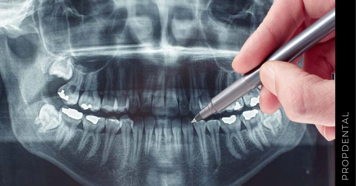 Radiografías dentales: ¿Son seguras?