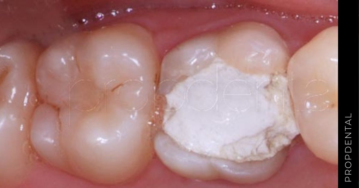 Razones de la sensibilidad después de un empaste dental