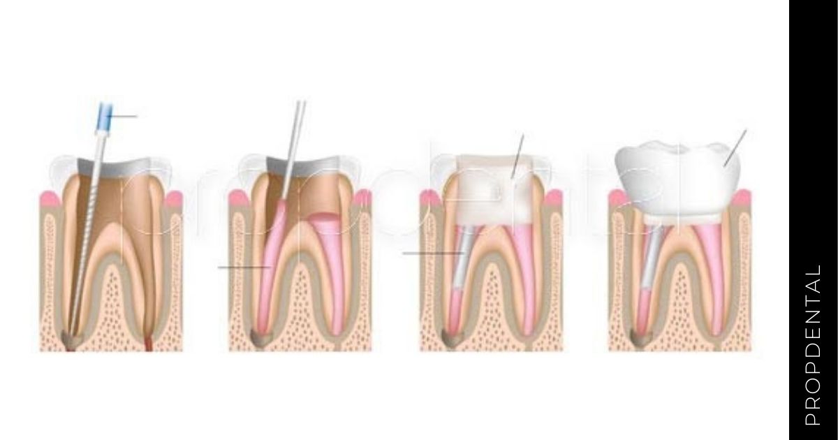 Razones por las cuales fracasa una endodoncia