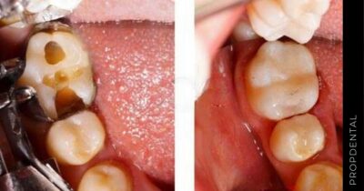 Reconstruir una pieza dental rota
