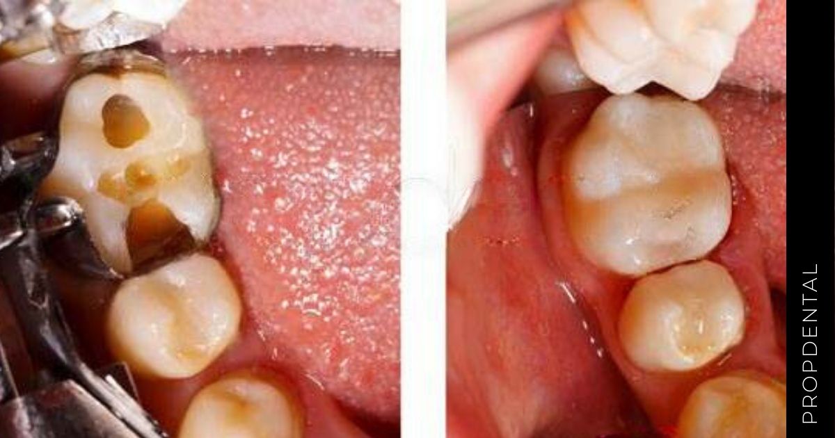 Reconstruir una pieza dental rota