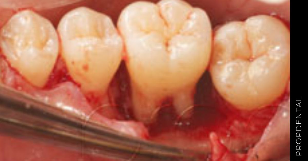 Regeneración de los tejidos periodontales destruidos