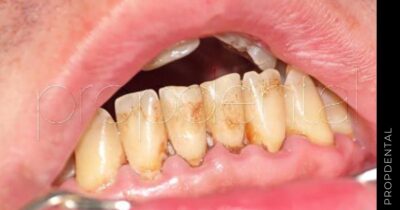 ¿Se puede evitar la acumulación de placa en los dientes?