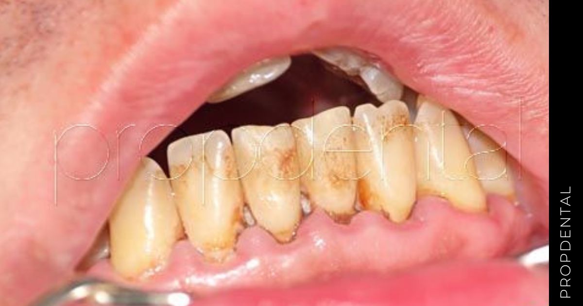 ¿Se puede evitar la acumulación de placa en los dientes?