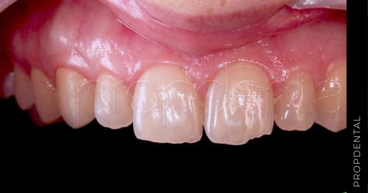 Signos y síntomas del diente fisurado