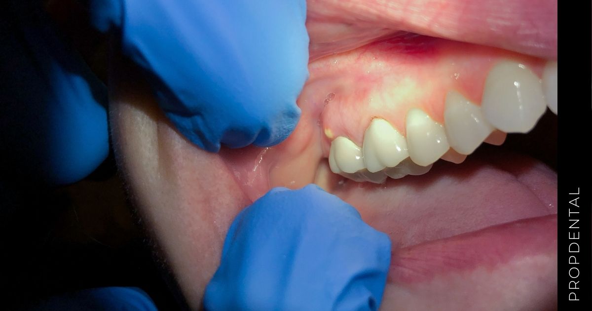 Síntomas del absceso dental