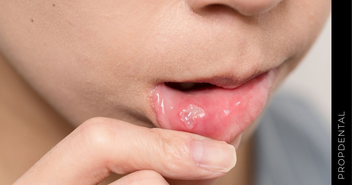 Síntomas y tratamiento de la candidiasis oral