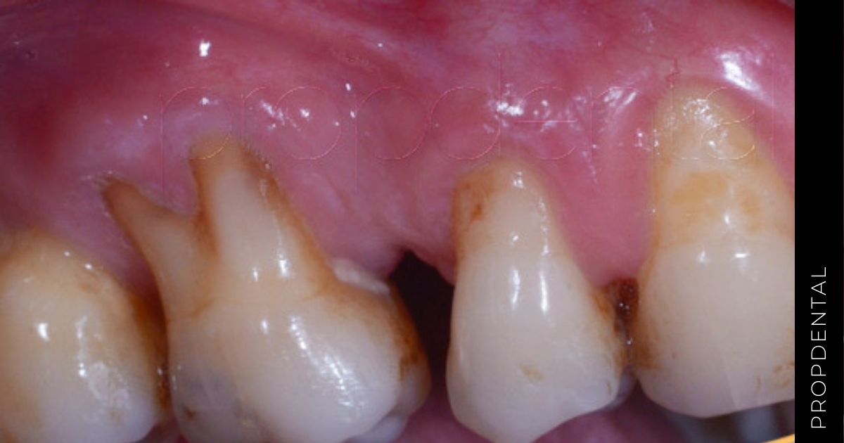Sintomatología de las enfermedades periodontales