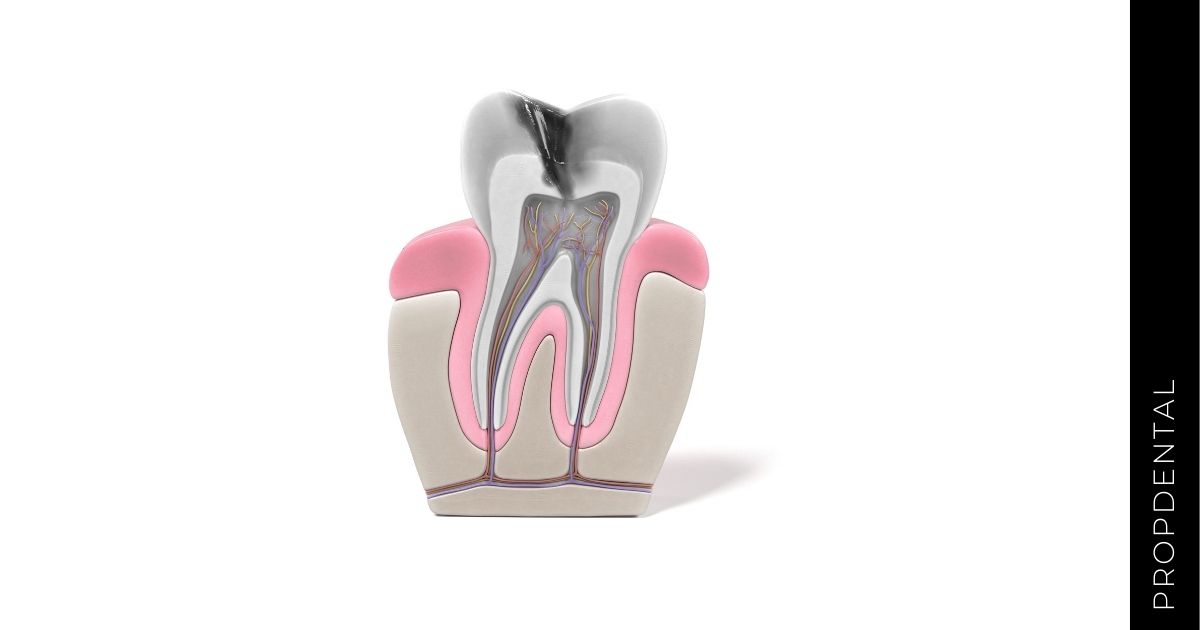 Situaciones en las cuales se requiere una endodoncia