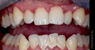 Soluciones para el apiñamiento dental
