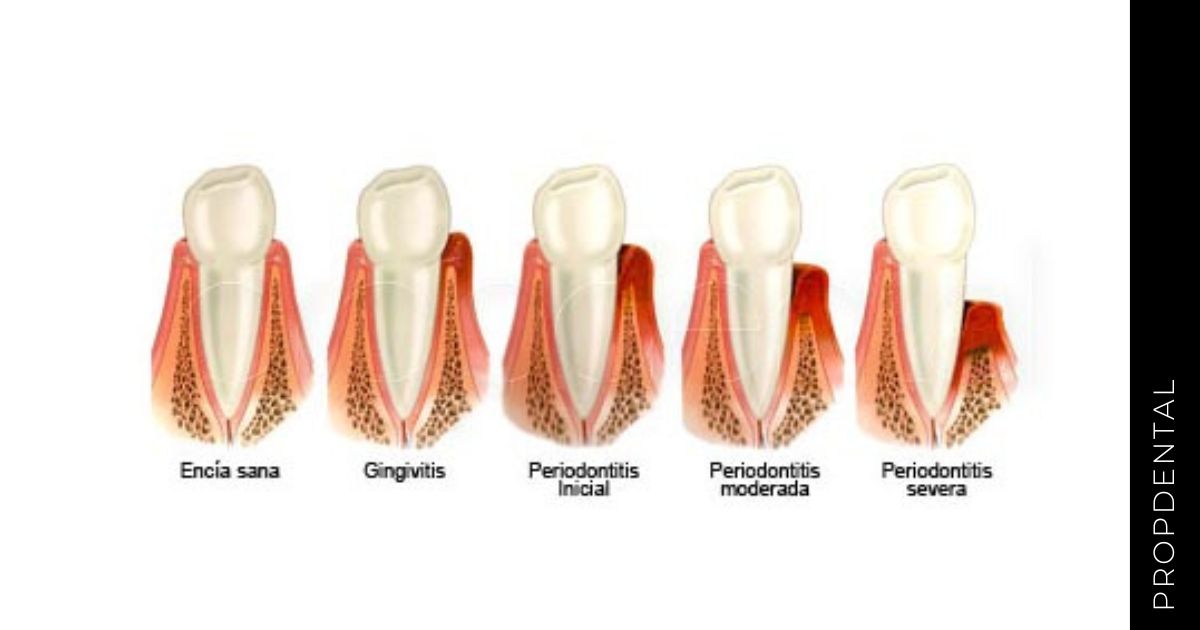 Tipos de enfermedad periodontal