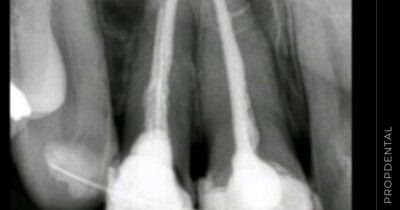 Tipos de infecciones dentales