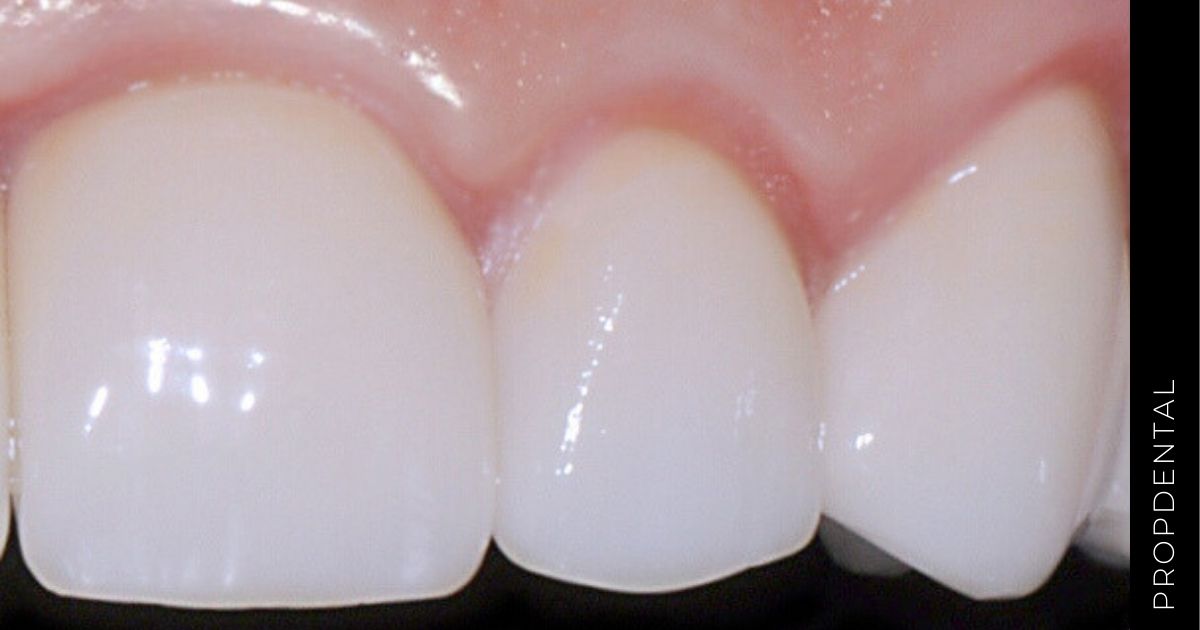 Tipos de porcelana dental