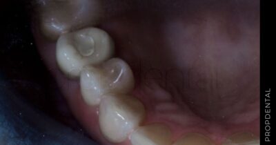 Empaste dental de composite
