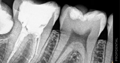 Tratamiento de endodoncia