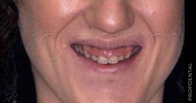 Tratamiento de la sonrisa gingival