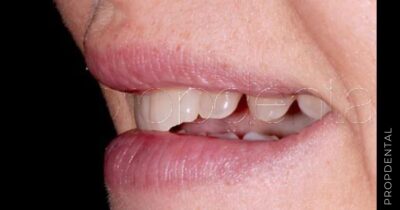 Tratamientos para dientes rotos y agrietados