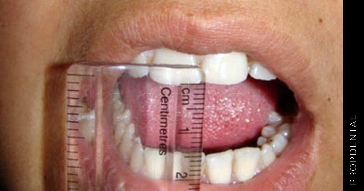 Trismus dental