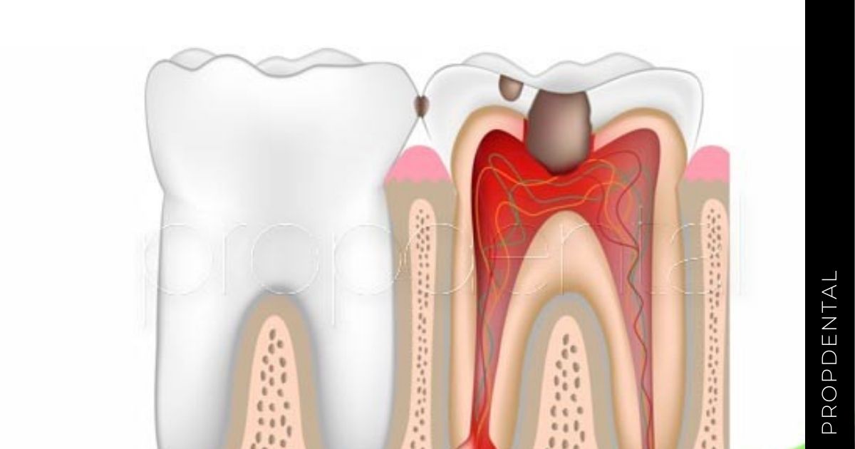 Variedades de pulpitis