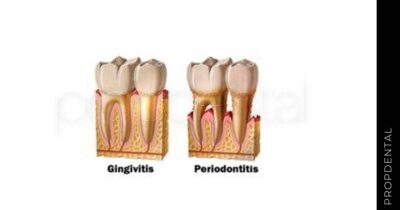 Diferencias entre la gingivitis y periodontitis