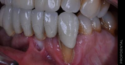 Causas de la periodontitis