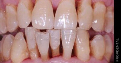 ¿Cómo tratar la periodontitis avanzada?