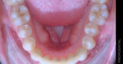 Cuidados durante y después del tratamiento con ortodoncia
