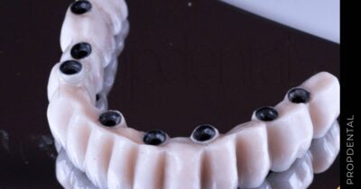 Prótesis metal porcelana sobre implantes